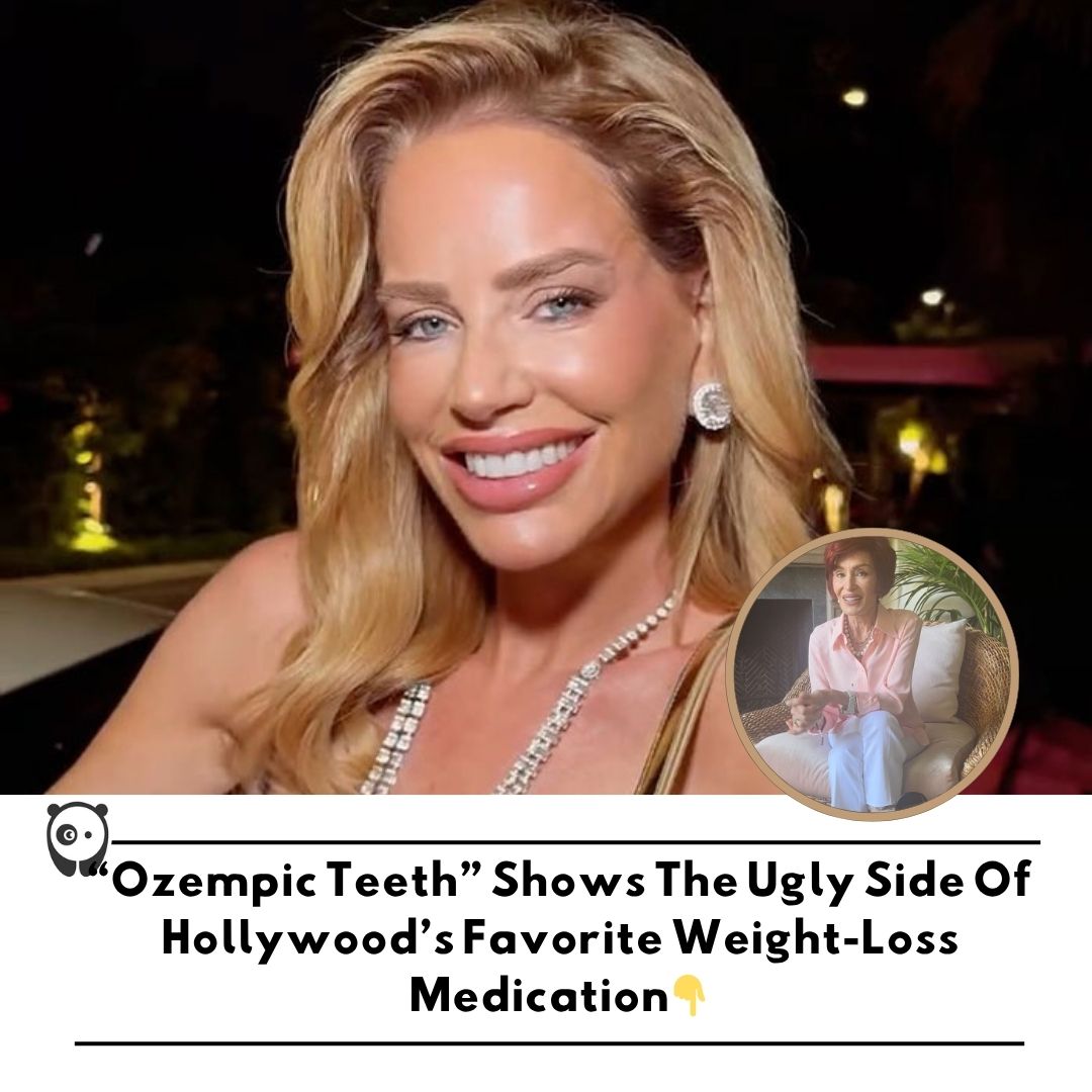 “Ozempic teeth” shows the ugly side of Hollywood’s favorite weight-loss medication. Click link in bio for more!