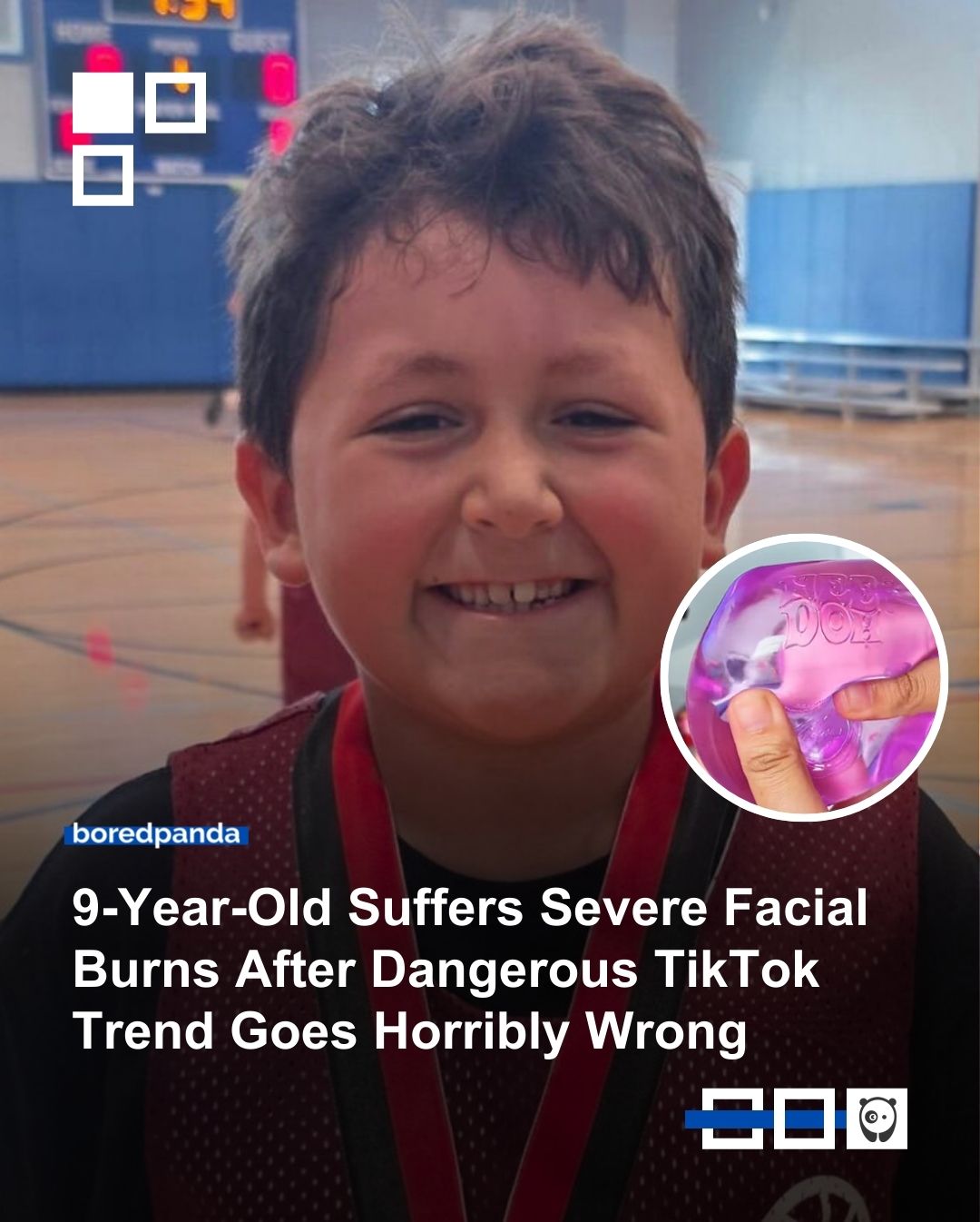 A Chicago child is recovering from serious burns after attempting a viral social media trend involving a sensory toy. Doctors say multiple children have been injured in similar incidents.

Details at the link in our bio.