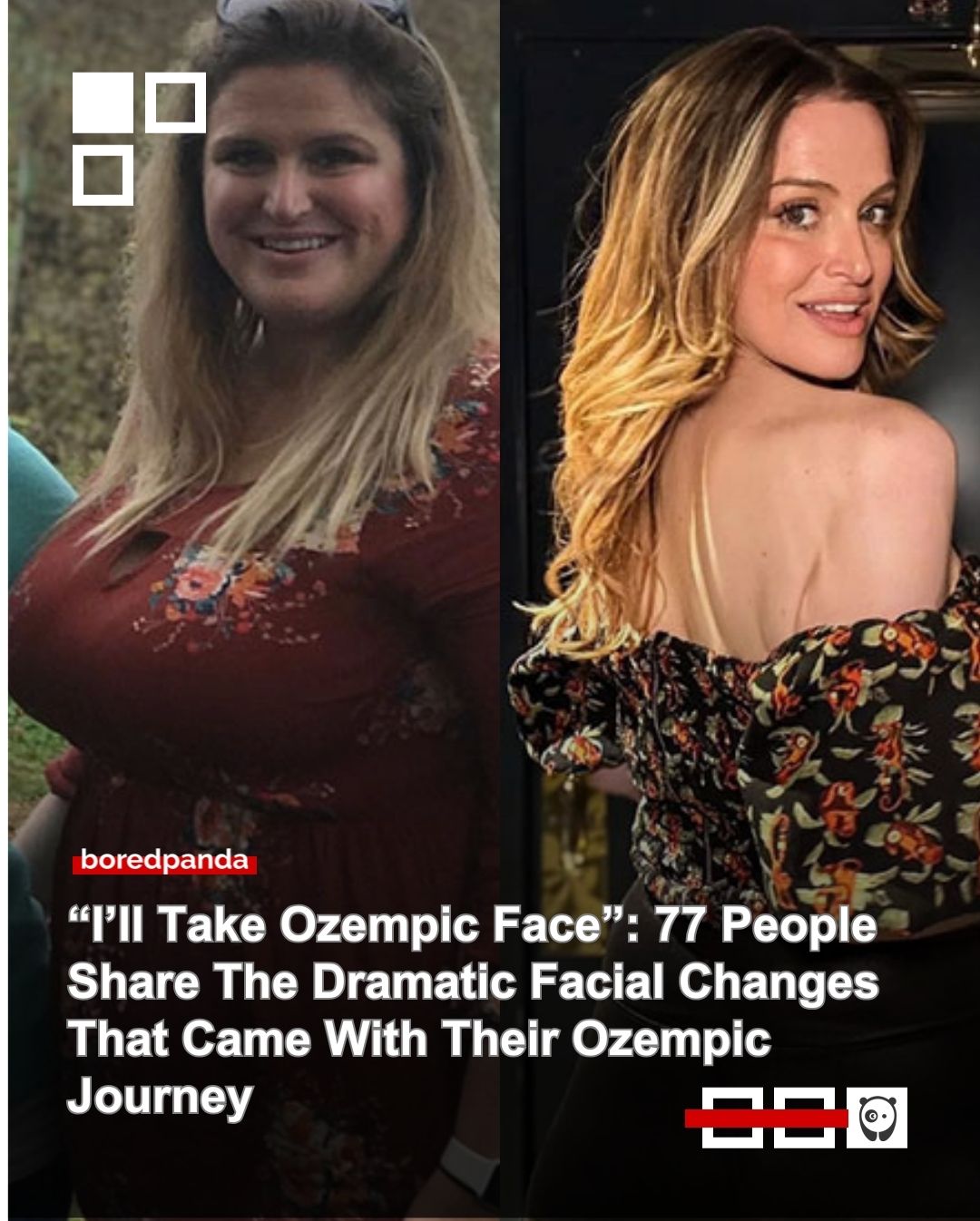 Once used primarily for diabetes, Ozempic surged into the mainstream in 2023 as a celebrity-backed weight-loss fix. Many have since shared before-and-after photos, including those embracing “Ozempic face.”

See them at the link in our bio.