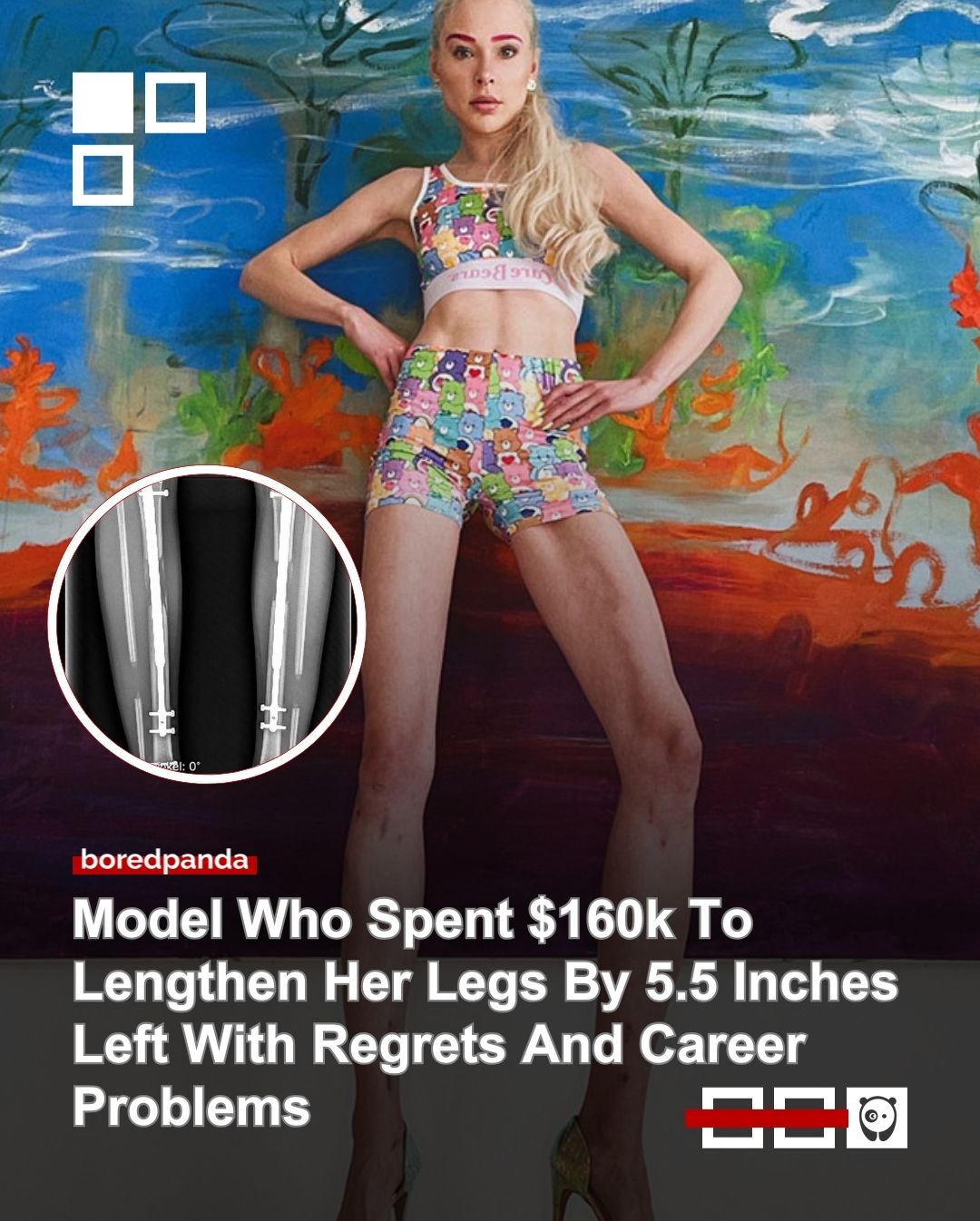 Theresia Fischer, the reality star who went viral for leg-lengthening surgery, is now facing serious health consequences.

After spending over €150,000 to increase her height, she’s reportedly battling chronic bone infections.

What was meant to be a transformation has taken a troubling turn. Read the full story at the link in our bio.