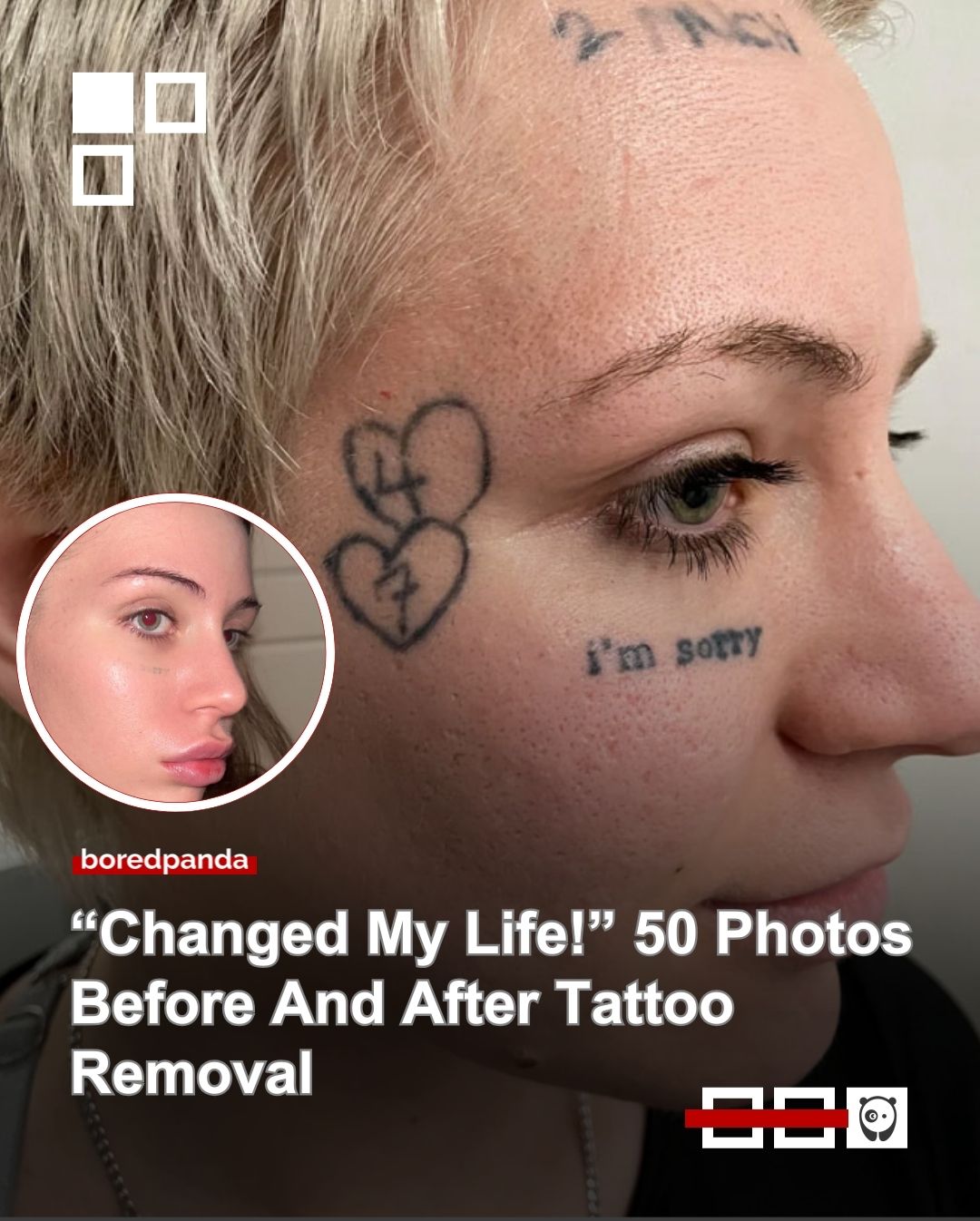 Back in the day, tattoos used to be forever. That's why we're still warned to think twice about getting tattoos today. But nowadays, tattoo removal exists, and experts say that removing standard black tattoos has up to a 90% success rate.

We've gathered the most impressive and successful examples of tattoo removal and present them to you here. Read more at the link in our bio.