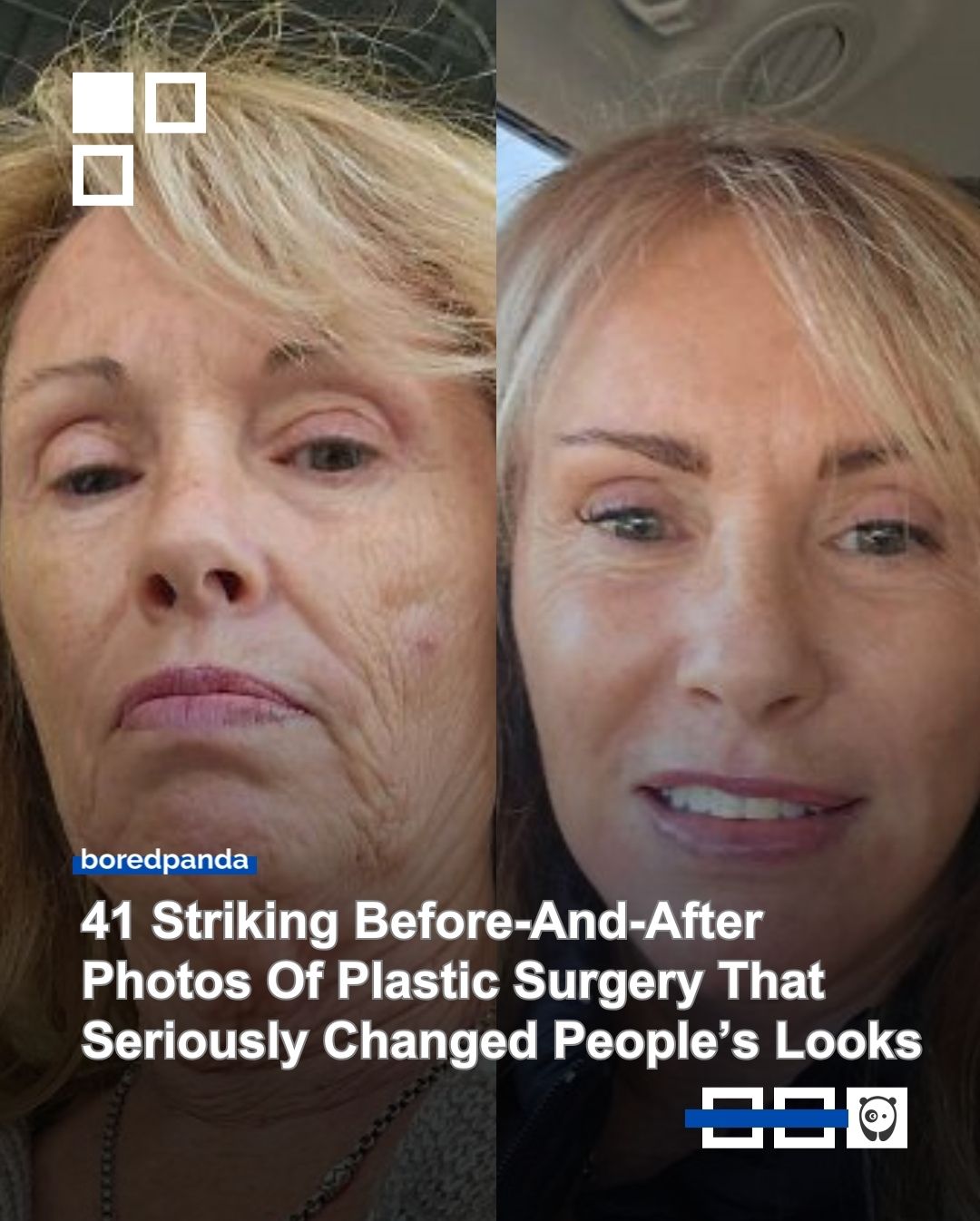 Plastic surgery is no longer rare, and it’s becoming more accessible every year.

People online have shared Incredible results, and we have gathered the most viral transformations. Scroll through 41 before-and-afters at the link in our bio.

Do you support plastic surgery, or are you against it?