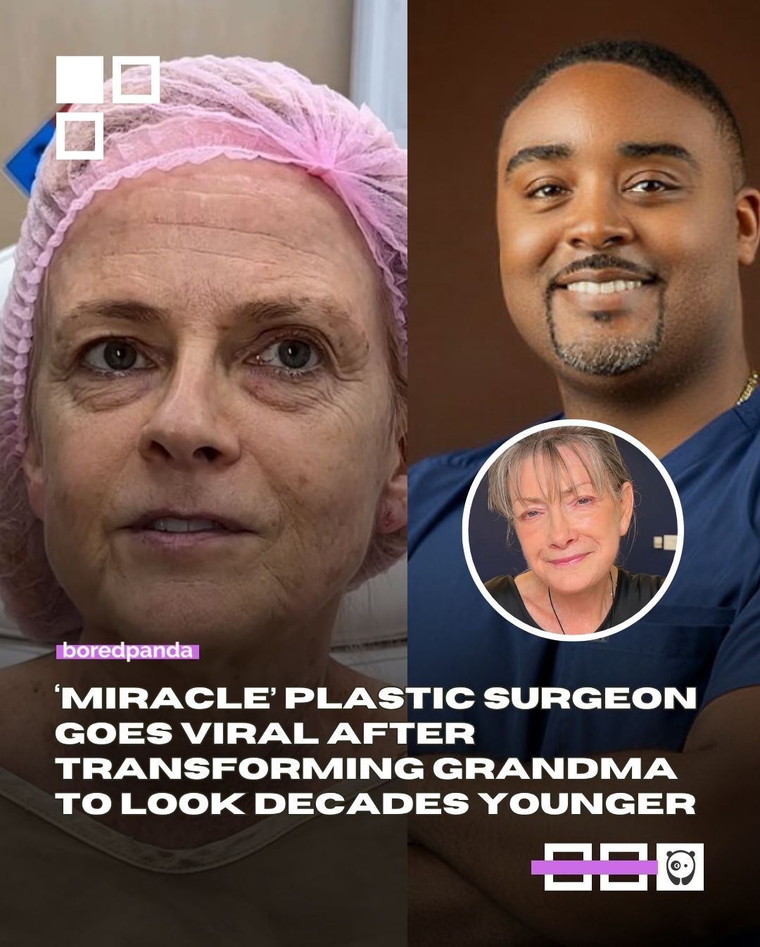 A plastic surgeon has gone viral after performing a facelift on a 70-year-old woman, achieving a result so striking that she claimed he “took 30 years off” her appearance.

However, not all cosmetic procedures receive positive reactions.

Click link in bio for details 🔗

#facelift #viral #surgery
